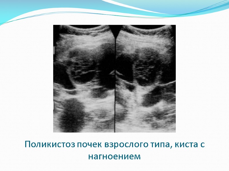 Поликистоз почек взрослого типа, киста с нагноением